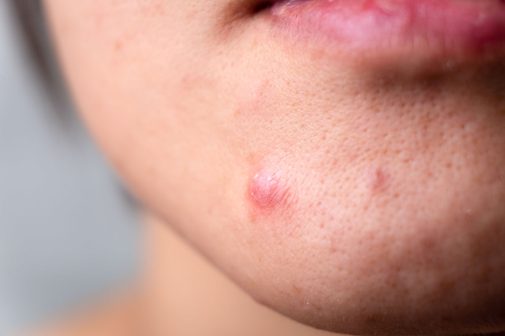 does-protein-powder-cause-acne-or-spots-vivo-life